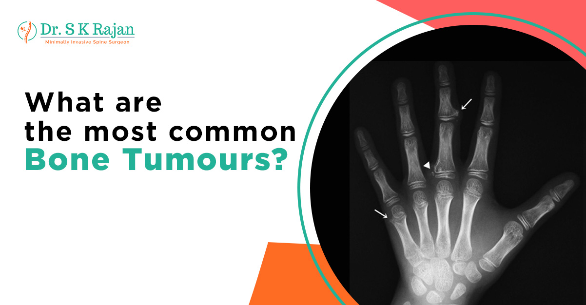 What are the most common bone tumours